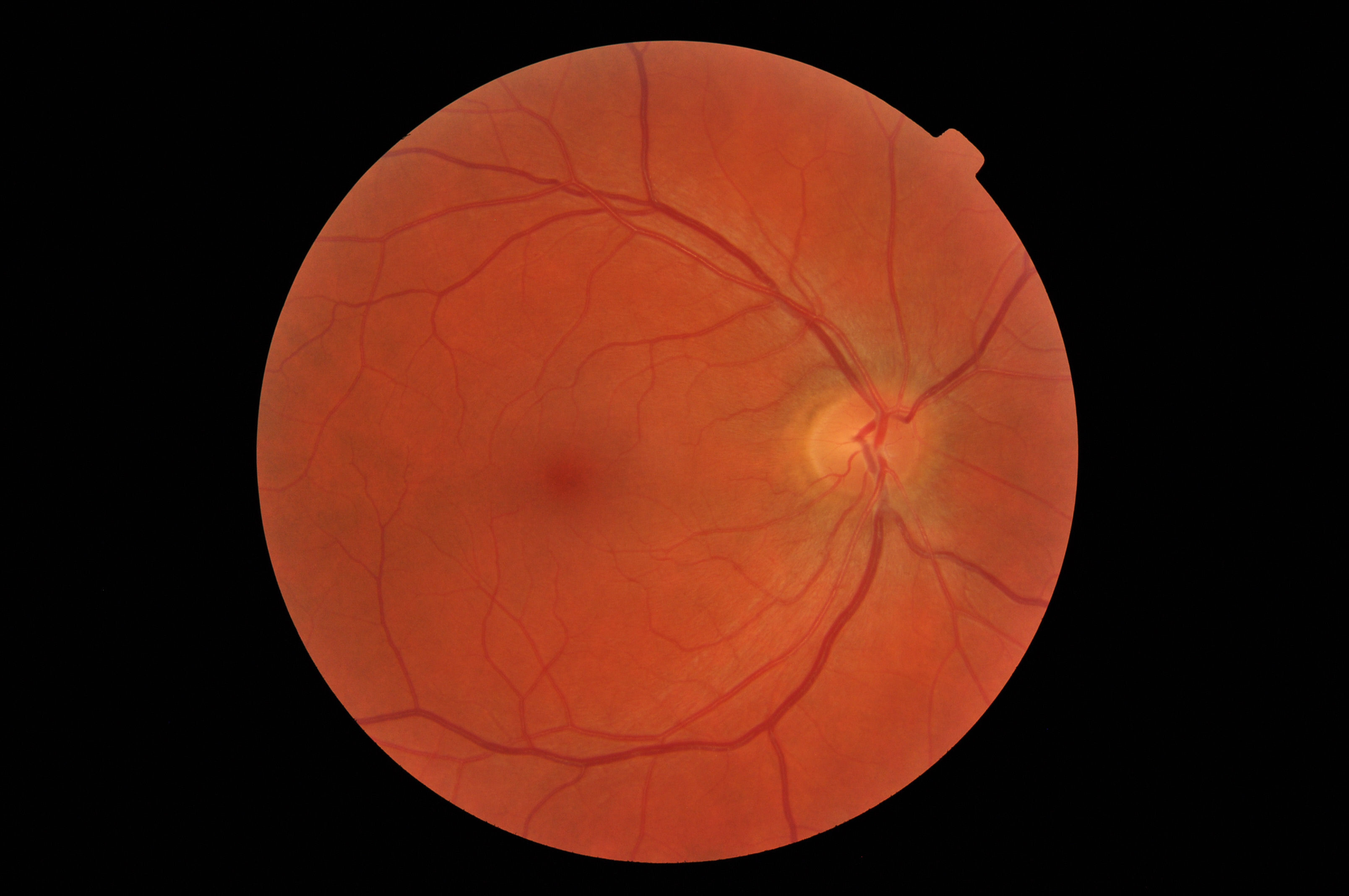 normal retina fundus photo